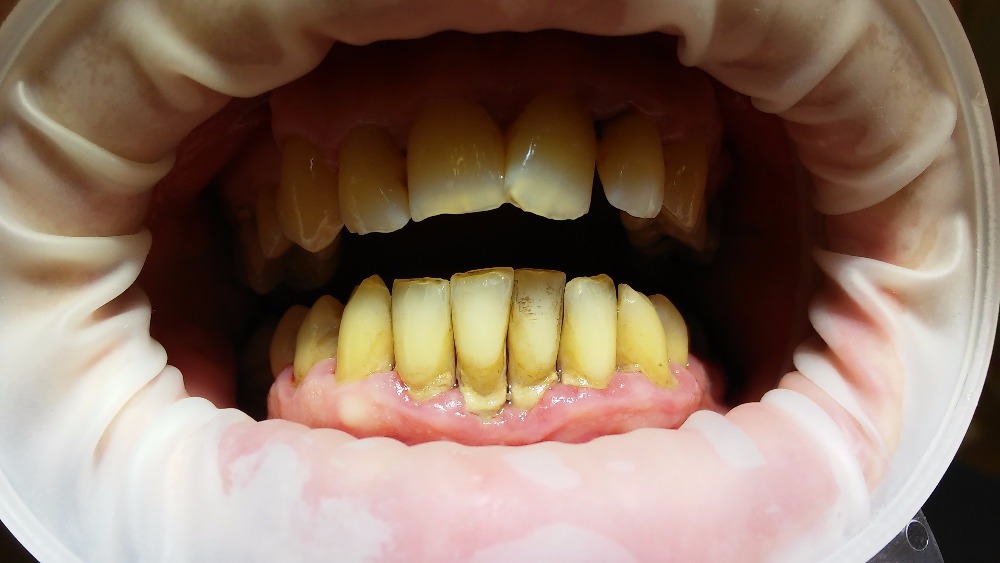 které se usazují na zubech a dásních. Ty uvolňují toxiny, které dásně poškozují, vznikají bolestivé záněty, které nejdřív napadají dásně,