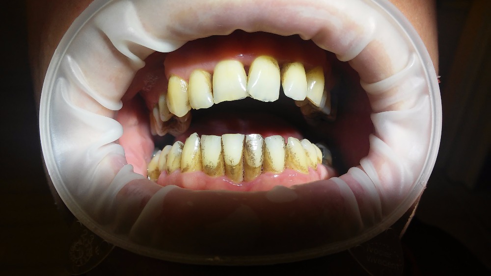 2. stádium znamená už rozvinutý zánět. Objevuje se bolest, nepříjemné brnění, tlak a napětí. Dásně jsou zarudlé, oteklé, mezi zubem a dásní vznikají kapsy, které se plní hnisem.