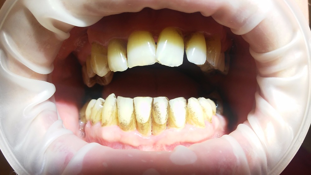 Nejprve se obnažují zubní krčky, poté se zuby rozestupují a začínají se viklat. Krvácení z dásní je časté a pach z úst velmi nepříjemný.