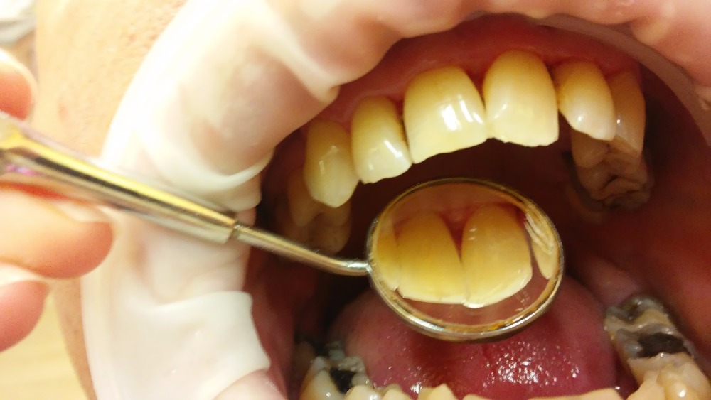3. stádium je charakteristické uvolňováním zubů. Je postižen závěsný aparát a někdy vlivem zánětu ustupuje čelistní kost.
