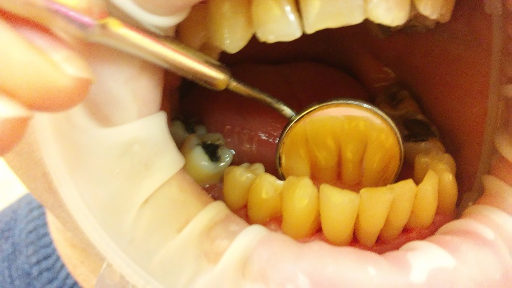 I jazyk a dásně je třeba čistit, ulpívají na nich rovněž bakterie, které se množí a rozmáhají se po celé ústní dutině. Na jazyk jsou speciální kartáčky, v případě nouze lze použít kávovou lžičku jako škrabku.
