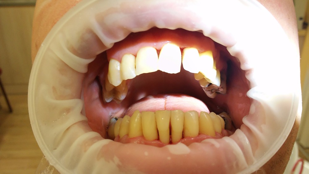 Pozor na nasycené a sladké nápoje, ulpívají na zubech a mohou být příčinou zubního kazu i paradentózy.
