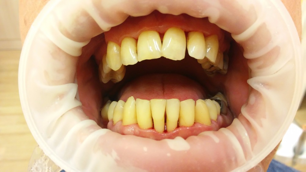 nejlépe však po každém jídle. Zubní plak musí být odstraňován i v mezizubních prostorech pomocí dentální nitě nebo mezizubního kartáčku.